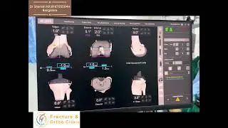4.5 deg valgus- Knee - Apex Neutral - Balancing using MAKO ROBOTIC ARM