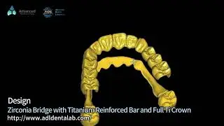 Zirconia Bridge with Titanium Reinforced Bar and Full Ti Crown