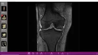 Fratura por insuficiência do côndilo femoral