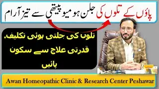 Burning Feet Soles Fast Relief with Homeopathy