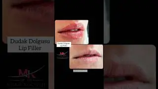 Dudak Dolgusu, Lips Filler