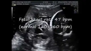 Fetal congenital heart block