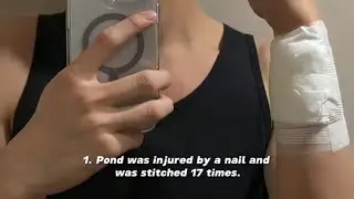Pond got 17 stitches during leap day series shooting