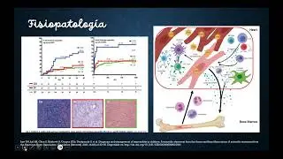 Miocarditis Aguda &iquest;Qu&eacute; hay de nuevo?