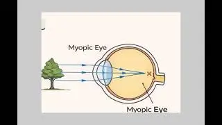Myopia defect 👁️👁️&zwj;🗨️_board exam imp questions for 5 marks Near-Sightedness Complete Revision Sheet