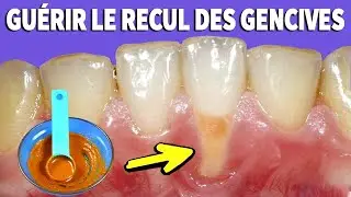 Repair Your Receding Gums With This Simple Recipe