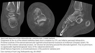 Posterior Talar Process Fracture Imaging