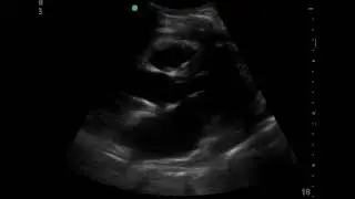video 6 pericardiocentesis cropped