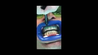 EPIC Laser Teeth Whitening System | Vienna VA Dentist | Tysons Dentistry