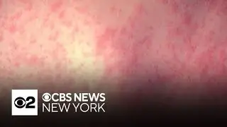 N.J. health officials warn of potential measles exposures at Newark Liberty Airport