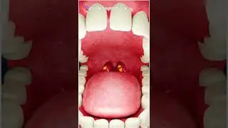 Tonsil Stones?😱 But WHY do you have those? - By Kishor Singh #shorts