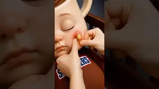 Pimple popping process is so satisfying 😂🤯