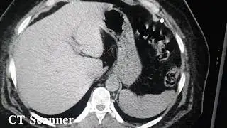 lithiase r&eacute;nal .TDM Abdominale sans injection