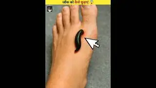 How to remove a leech? 😱