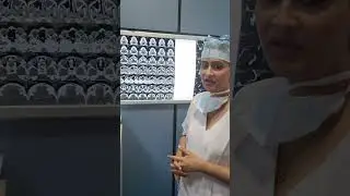 CT SCAN Finding by DR.Saloni Sinha ...Case of Massive AC Polyp
