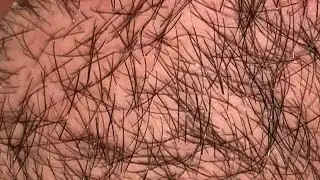 ASMR ingrown satisfying long hair video #1000subscriber #skincare #asmrtriggers