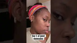 Good Molecules Niacinamide update! Pores are shrinking but the whiteheads 👀! #pores #goodmolecules