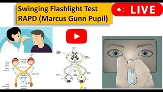 Mastering the Swinging flashlight test during RAPD or Marcus Gunn Pupil examination