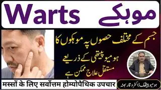 Warts / Mohky موہکے मौसा Homeopathic Treatment By Dr Waqar Bhutta In Urdu / Hindi