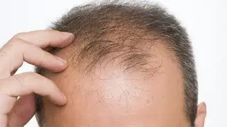 🍀6 alimente care pot combate pierderea parului🔔