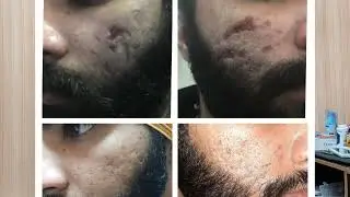 Unbelievable Results From CO2 Laser Treatment: See the before-and-after!