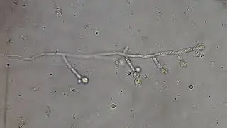 Chlamydospores of Candida albicans in clinical sample sputum KOH mount