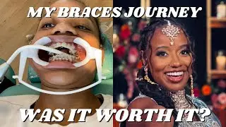 AND JUST LIKE THAT.. MY BRACES ARE OFF!