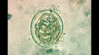 Schistosoma japonicum ; Overview, Transmission, Diseases, Symptoms, Cancer risk