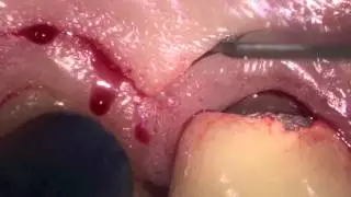 Crown Lengthening