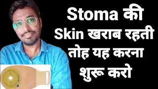 यह करो फिर कभी नहीं होंगी Stoma Skin problem | Colostomy Bag Skin care Hindi | colostomy bag leakage