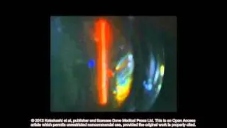 Classification of posterior vitreous detachment ID 54021 Supplementary video 2
