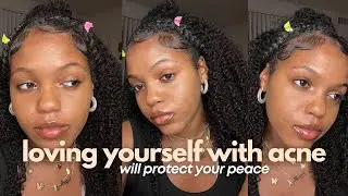 How to Love Yourself with Acne: my tips that protect my peace