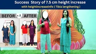 Success Story of 7.5 cm height increase  with heightincreaseinfo ( Tibia lengthening )