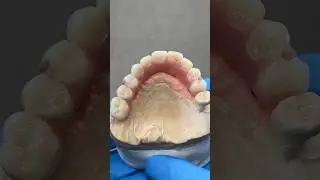 Syton 3500 Hybrid Denture #lsk121shorts #dental #teeth