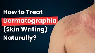 How to Treat Dermatographia (Skin Writing) Naturally? #urticaria #hive 