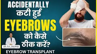 Accidentally कटी हुई Eyebrows को कैसे ठीक करें? Eyebrow Transplant In Delhi | Dr. PK Talwar