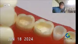 CLASE I RESINA COMPUESTA JUNIO 2024