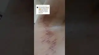 Stretchmarks sa Kilikili natanggal #stretchmarkremoval