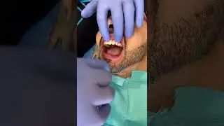 Does it hurt when you get your braces taken off?