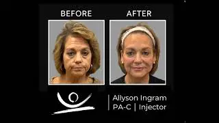 Allyson Before and Afters