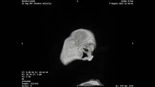 mri brain
