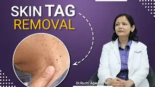 Skin tag removal delhi | Skin tag removal treatment | Skin tag removal by laser | Skin Tag removal