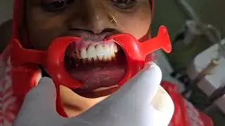 Missing Front teeth placement ,,, crown and bridge , anterior incisors ,, dr roshan shah