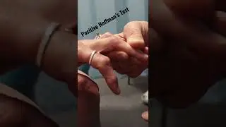 Positive Hoffman&rsquo;s Test in slow motion! #shorts #hoffman&rsquo;stest #orthoevalpal