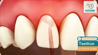 Soft Tissue Laser Gingivectomy