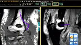 Case Review: Mechanism of Elbow Dislocation on MRI