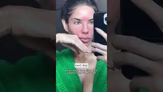 3 Month Cosmelan Transformation