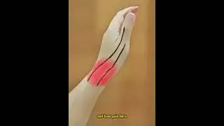 Тендовагинит Де Кервена: быстрое решение за 5 шагов! #шорты