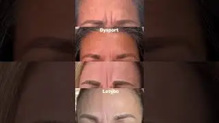 Dysport vs Letybo Korean Neurotoxin