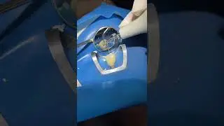 AGITA&Ccedil;&Atilde;O DE MEDICA&Ccedil;&Atilde;O INTRACANAL COM IRRISONIC